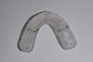 splint met ankers Spier tandprothetiek